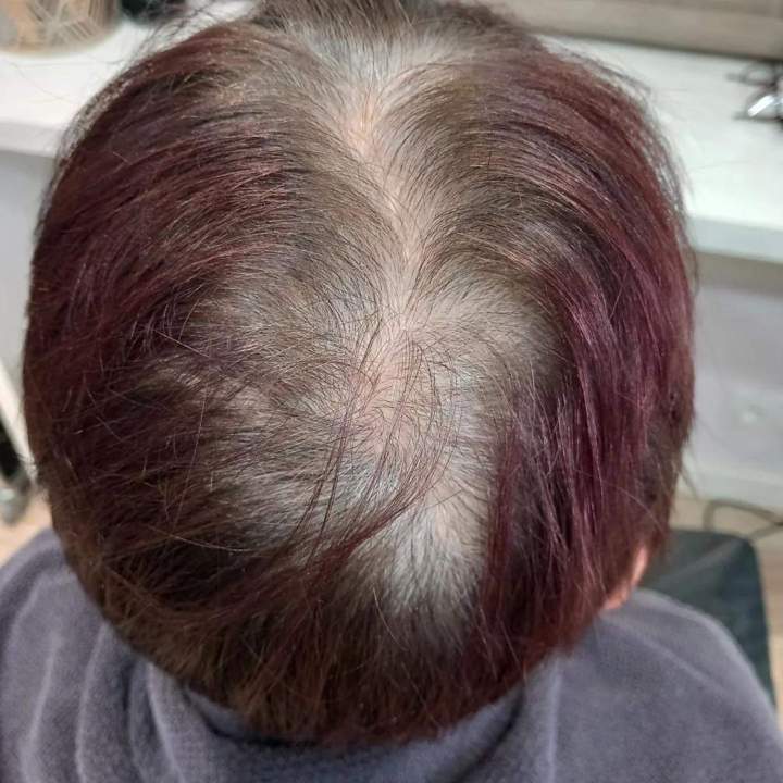 Prothèse capillaire Les Sables-d'Olonne