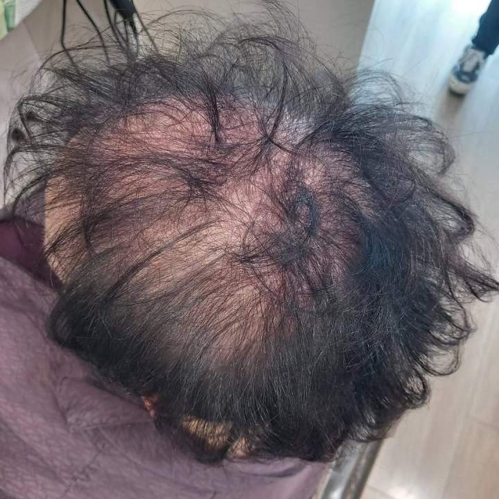 Prothesese capillaire avant 1