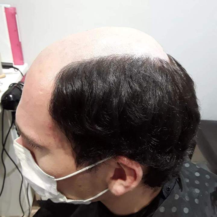 Analyse du cheveu Les Sables-d'Olonne